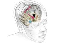 Implante cerebral pode ser alternativa para depressão severa