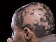 Empresa cria remédio para alopecia areata com 40% de eficácia na recuperação quase total do cabelo