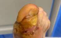 Britânico diz que aranha botou ovos dentro de seu dedão do pé