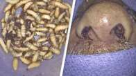 Na Flórida (EUA), paciente chega no médico com rosto inchado e acaba retirando 150 larvas vivas do nariz; veja o vídeo!