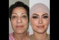 VIRAL: clínica estética da Turquia volta a causar polêmica com fotos de “antes e depois” inacreditáveis
